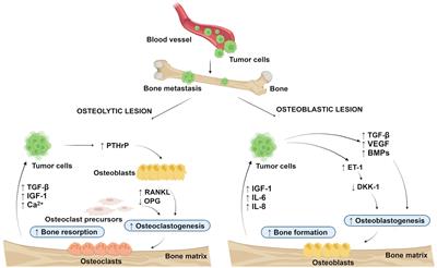 The link between bone-derived factors osteocalcin, fibroblast growth factor 23, sclerostin, lipocalin 2 and tumor bone metastasis